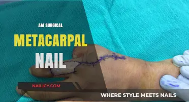 Surgical Metacarpal Nail: Innovative Fixation for Hand Fractures Explained