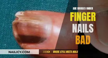 Uncovering the Mystery: Are Bruises Under Nails a Cause for Concern?