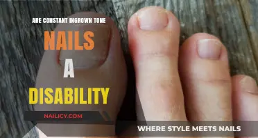 Constant Ingrown Toenails: Disability or Manageable Condition?