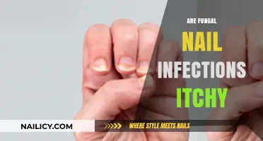 Are Fungal Nail Infections Itchy? Symptoms, Causes, and Relief Explained