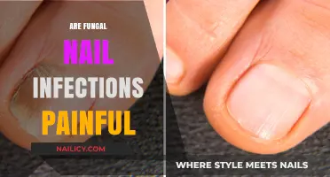Are Fungal Nail Infections Painful? Understanding Symptoms and Discomfort