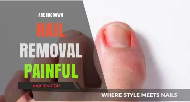 Ingrown Nail Removal: Is It Painful?