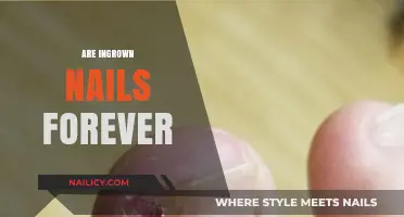 Ingrown Nails: Temporary Pain or Permanent Problem? Find Out Now