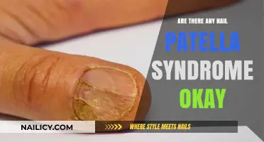 Understanding Nail Patella Syndrome: Challenges, Management, and Quality of Life