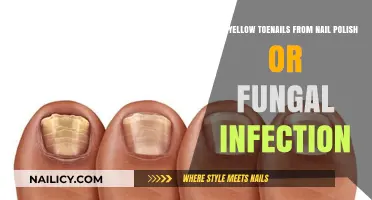 Yellow Toenails: Nail Polish Staining or Fungal Infection?