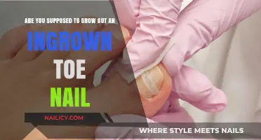 How to Treat an Ingrown Toenail at Home