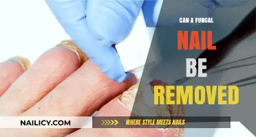 Fungal Nail Removal: Is It Possible?