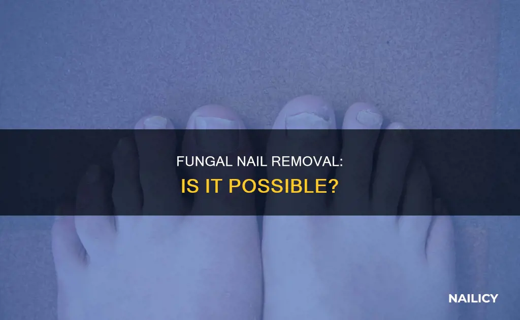 can a fungal nail be removed