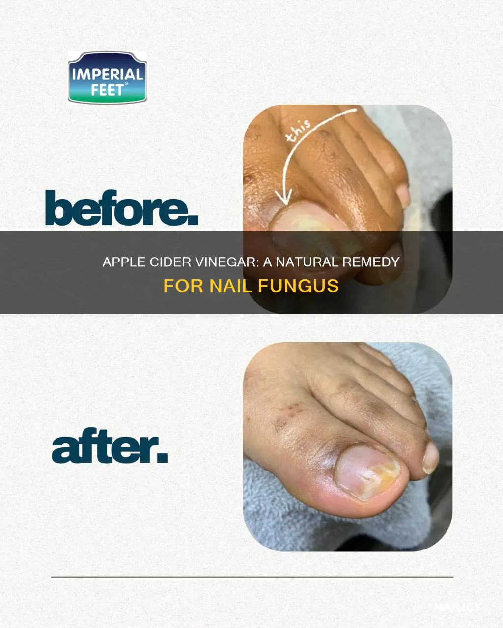 can acv remove finger nail fungus