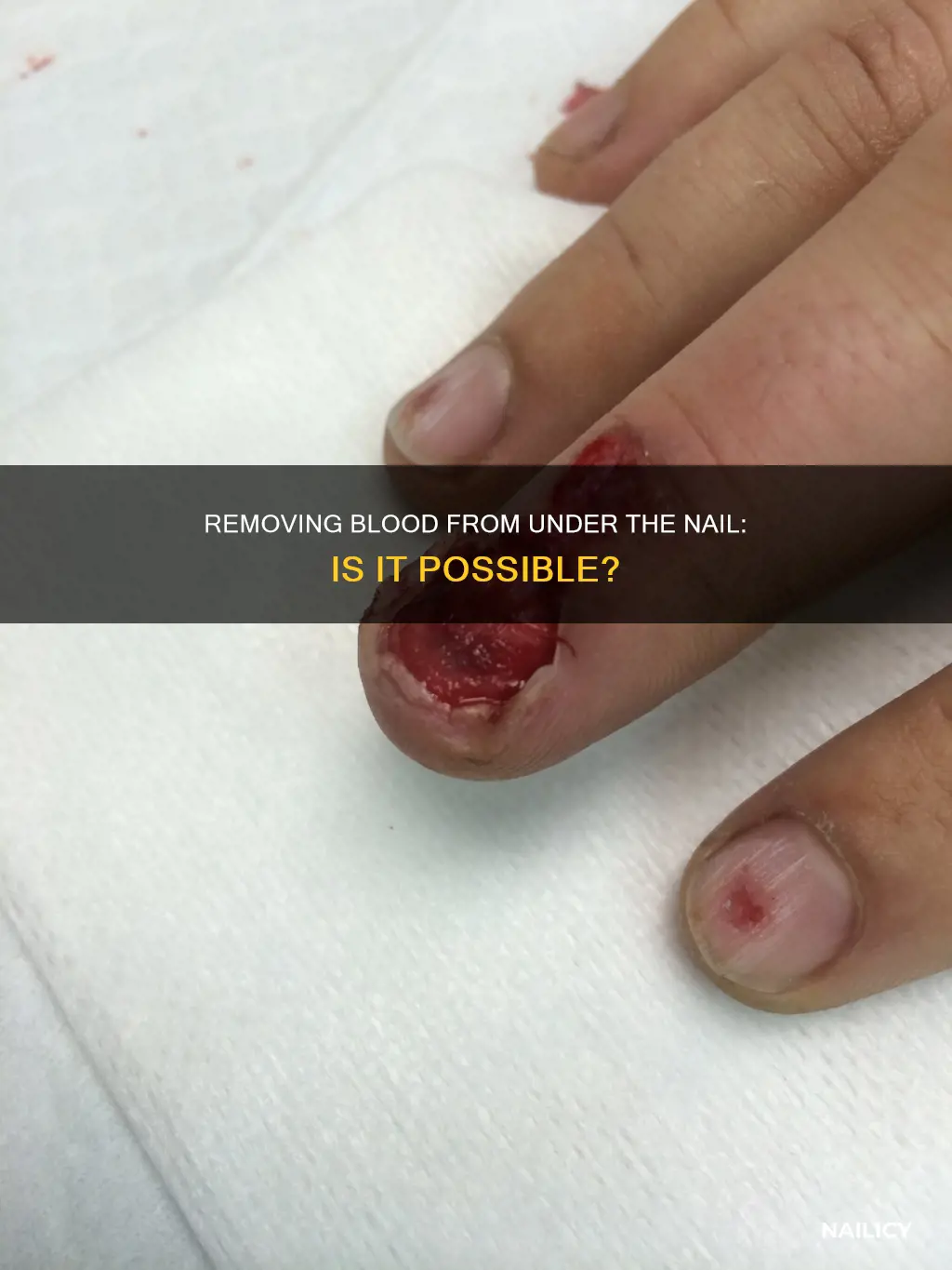 can blood be removed from under the nail