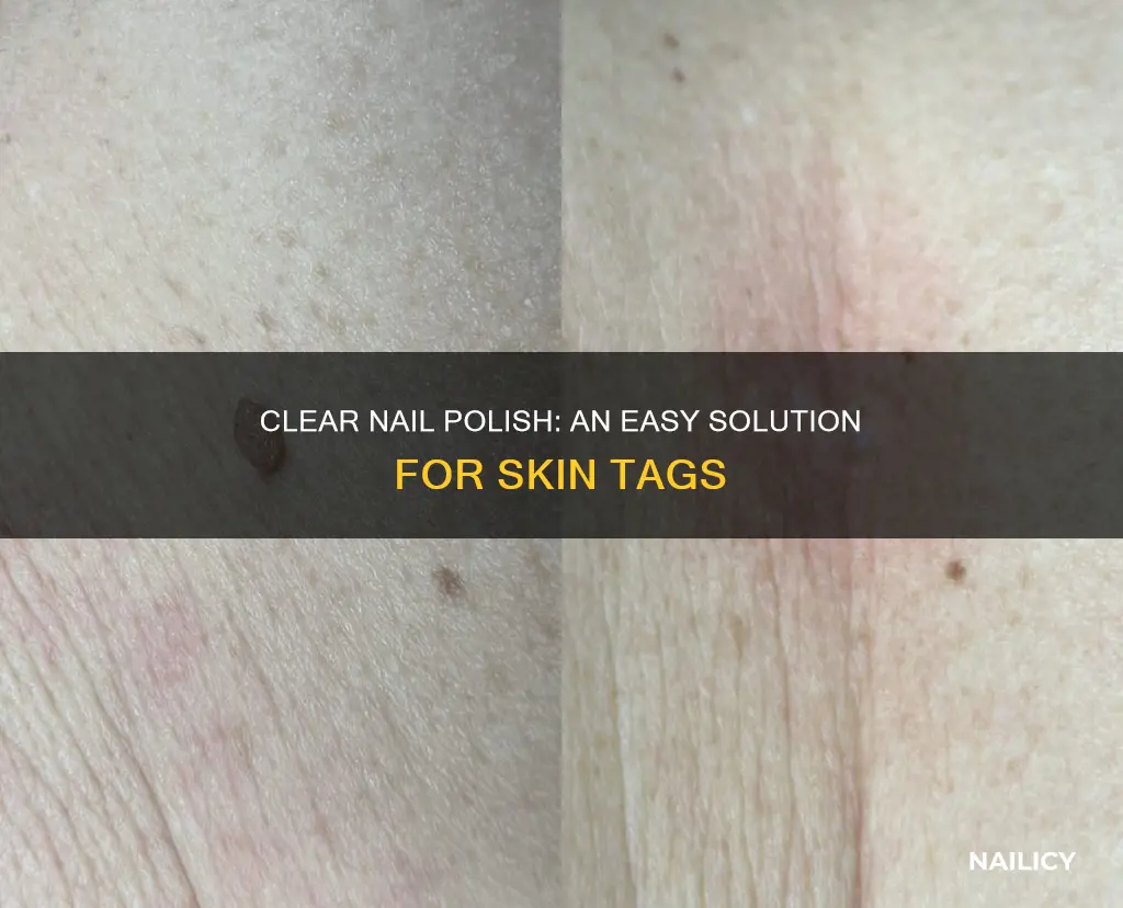 can clear nail polish remove skin tags