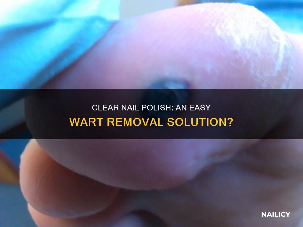 can clear nail polish remove warts