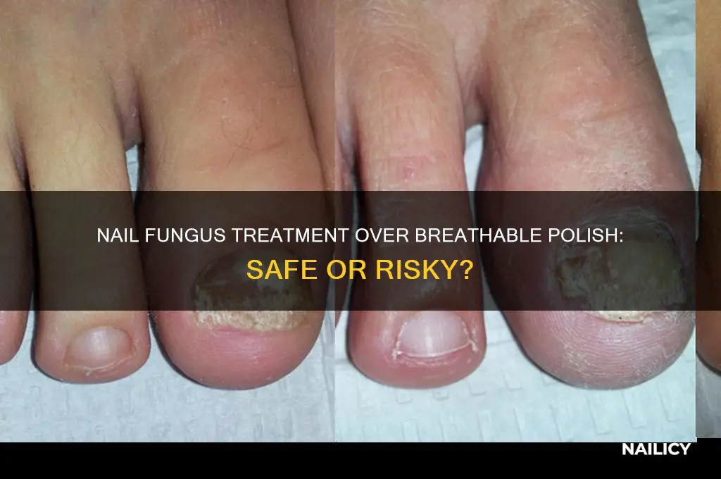 can i put nail fungus treatment over breathable nail polish