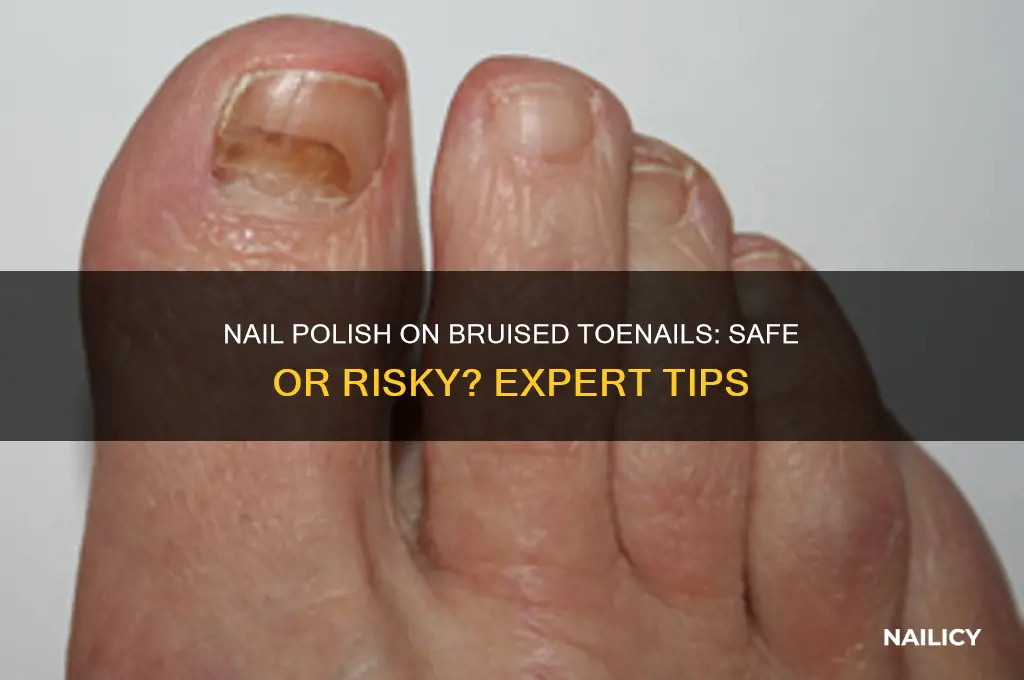 can i put nail polish on a bruised toenail
