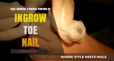 Easy Ingrown Toenail Partial Removal at Home