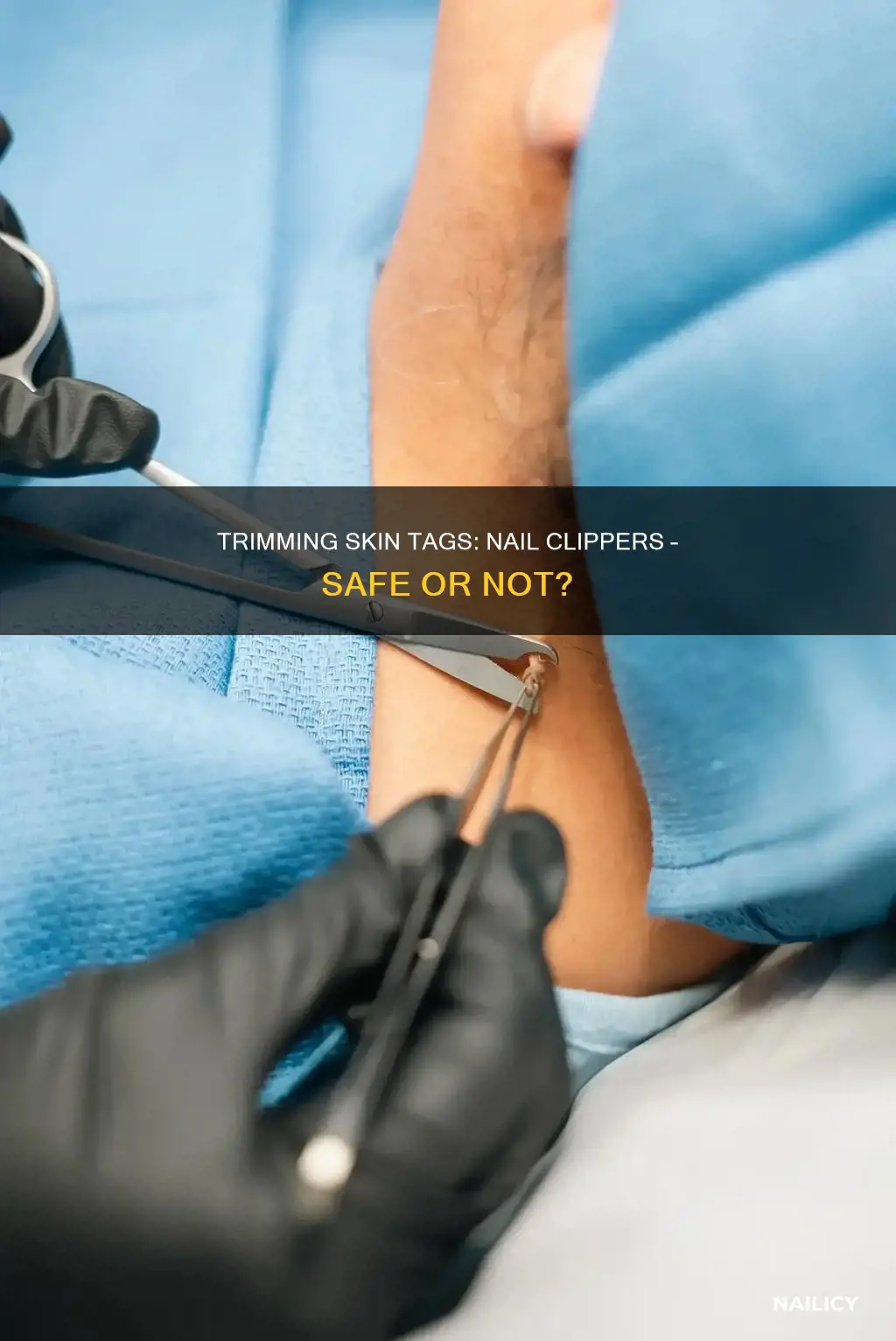 can i remove a skin tag with a nail clipper