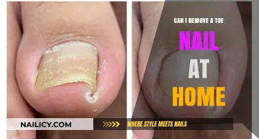 Toe Nail Removal: DIY or Doctor?
