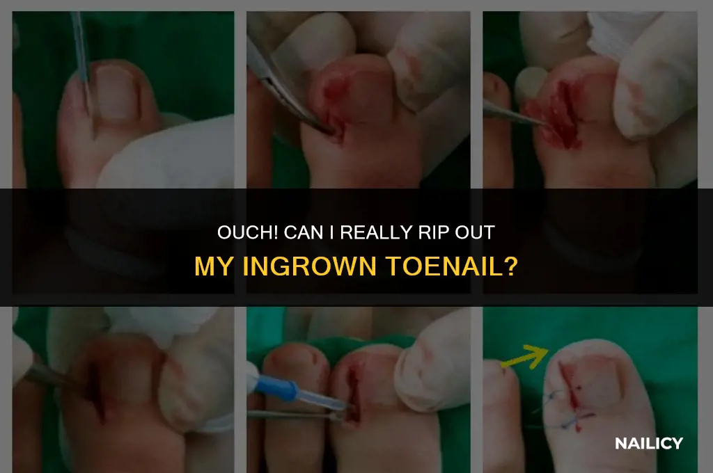 can i rip out my tow nail