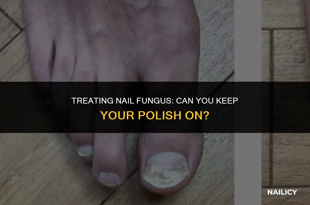 can i treat nail fungus while wearing nail polish