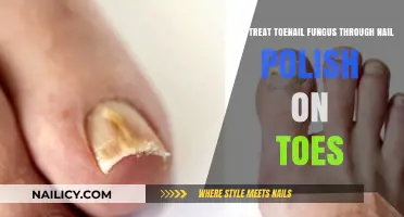Toenail Fungus Treatment: Can Nail Polish on Toes Cure It?