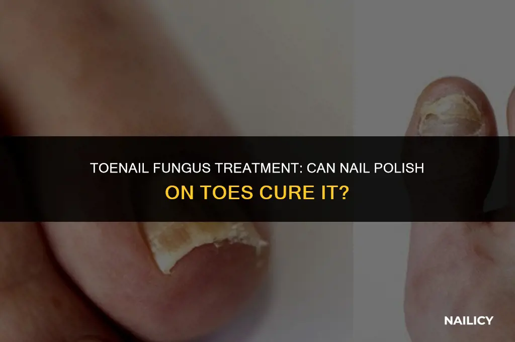 can i treat toenail fungus through nail polish on toes