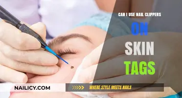 Safe Removal of Skin Tags: Nail Clippers or Medical Tools?