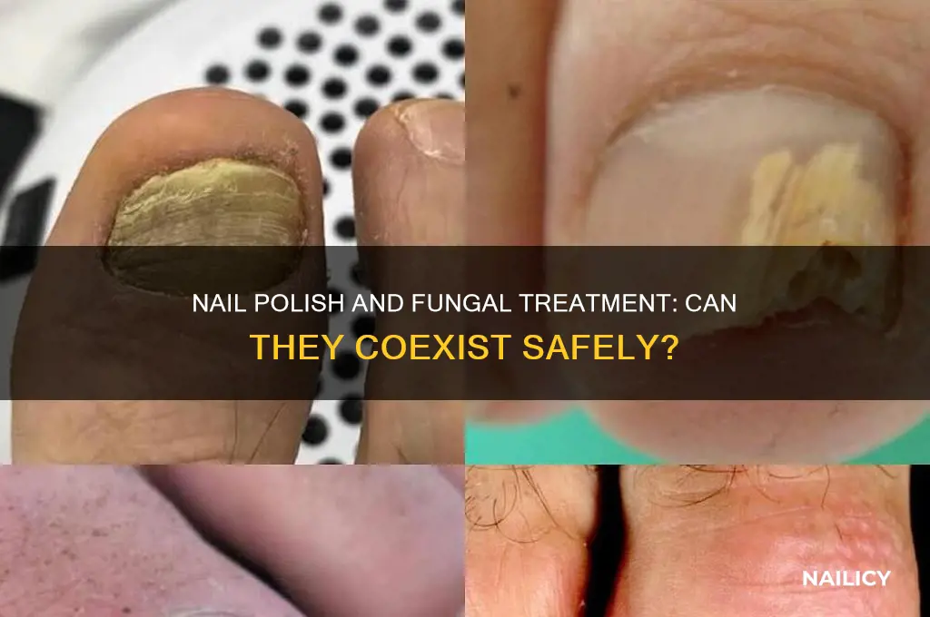 can i use nail polish when using fungal nail treatment