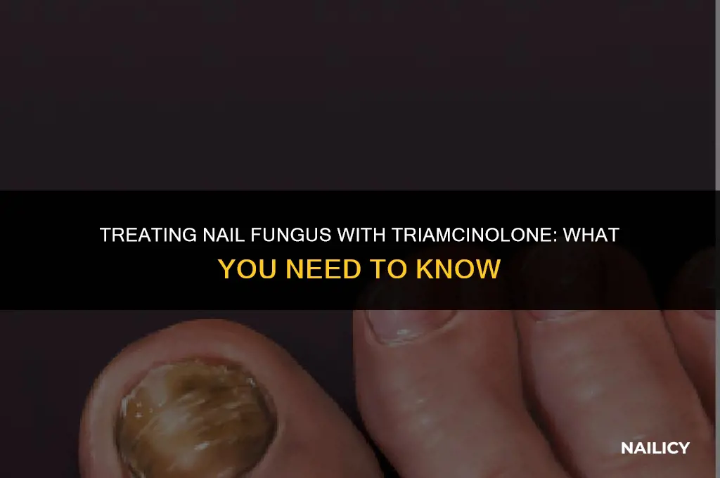can i use triamcinolone for nail fungus