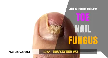 Exploring Witch Hazel as a Natural Remedy for Toenail Fungus