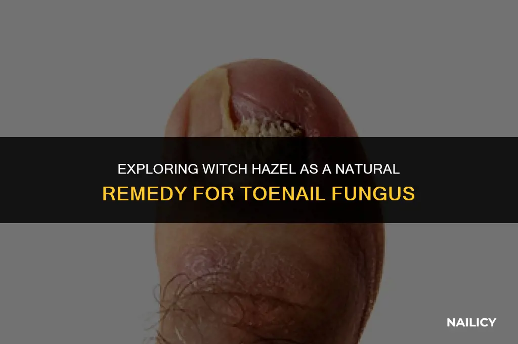 can i use witch hazel for toe nail fungus