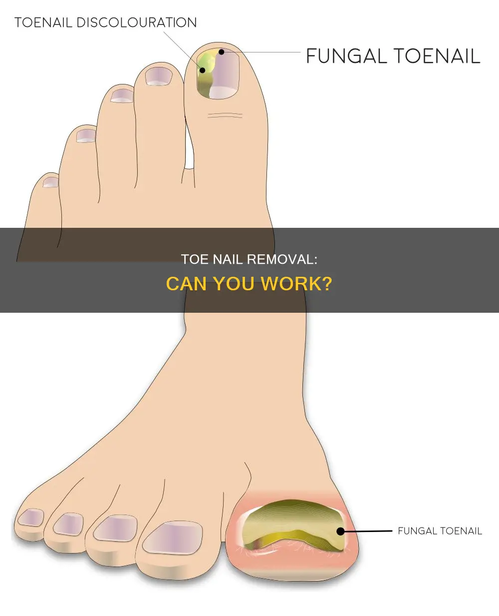 can i work after removing my big toe nail