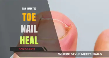 Can an Infected Toenail Heal on Its Own? Expert Insights