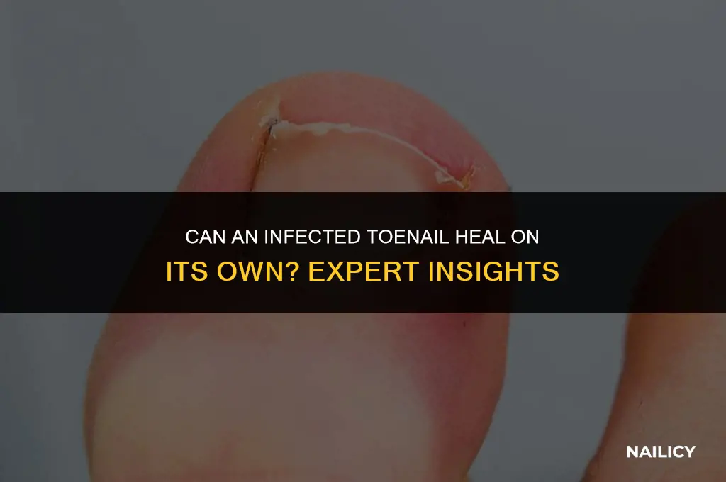 can infected toe nail heal