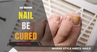 Natural Remedies to Cure Ingrown Nails: A Comprehensive Guide