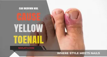 Can Ingrown Nails Lead to Yellow Toenails? Facts and Remedies