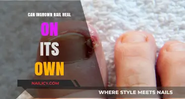 Natural Healing: Can Ingrown Nails Resolve Without Medical Intervention?