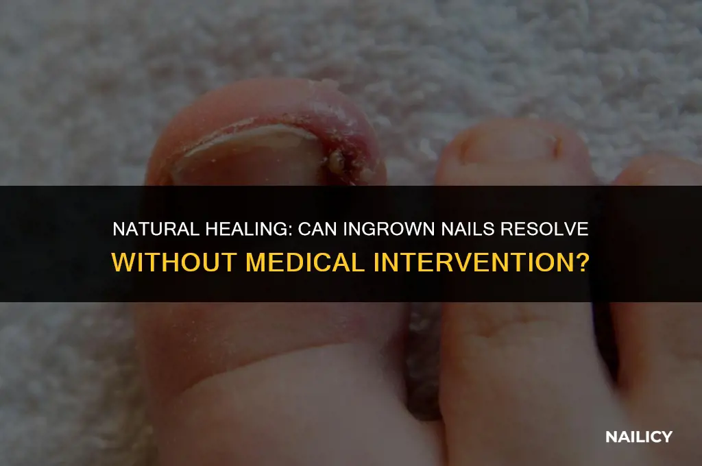can ingrown nail heal on its own