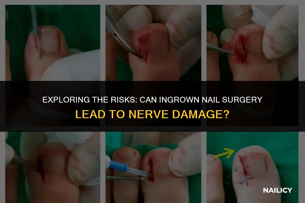 can ingrown nail surgery cause nerve damage