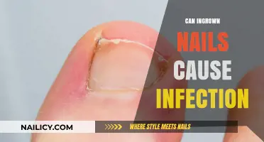 Ingrown Nails: A Painful Problem with Potential Infection Risks