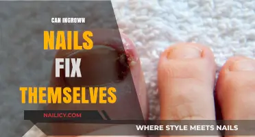 Can Ingrown Nails Heal on Their Own? A Comprehensive Guide