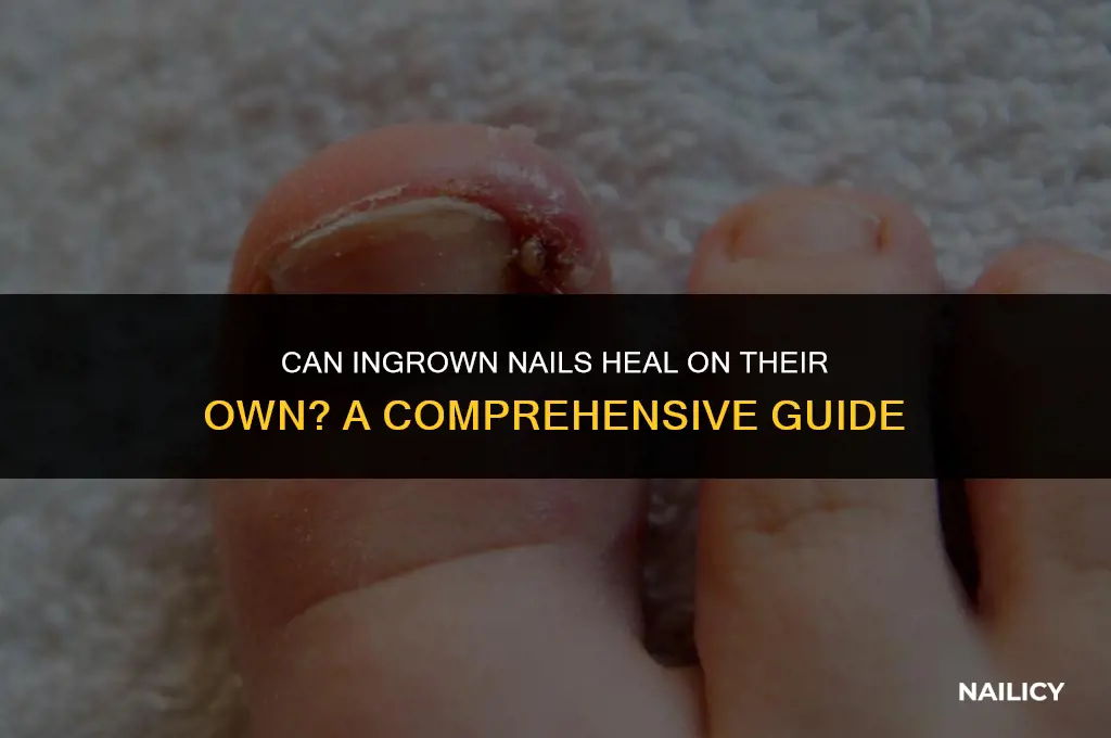 can ingrown nails fix themselves