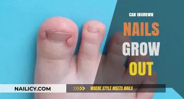 Ingrown Nails: Will They Grow Out or Require Treatment?