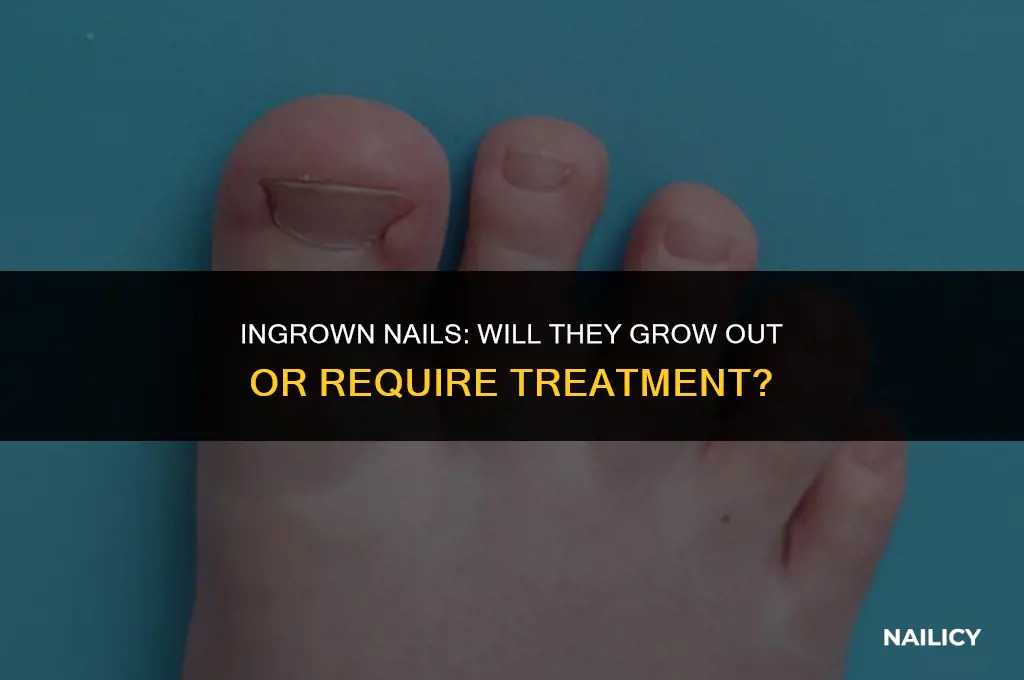 can ingrown nails grow out