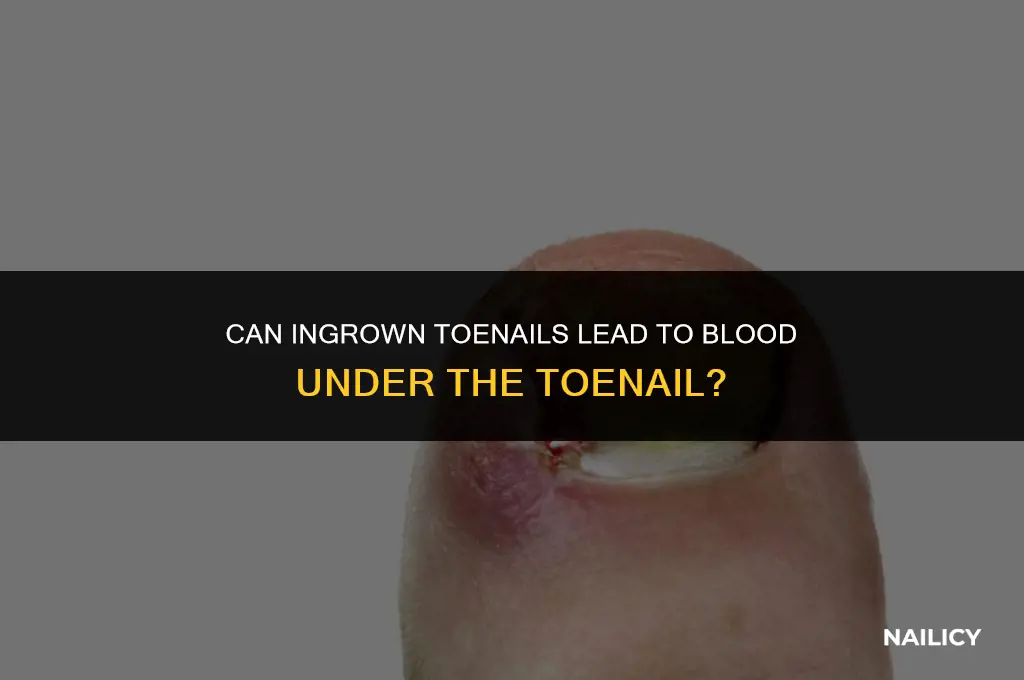 can ingrown toe nail cause blood under toemnail