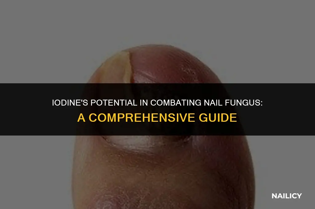 can iodine kill nail fungus