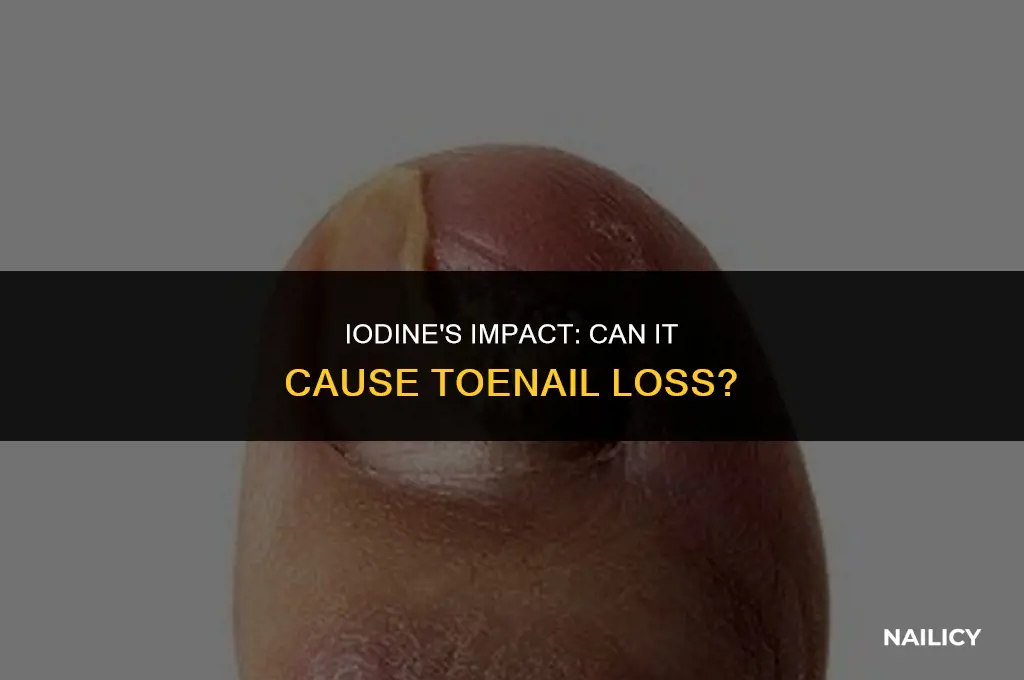 can iodine make you toe nail fall off