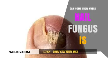 Unveiling Nail Fungus: Iodine's Surprising Detection Role