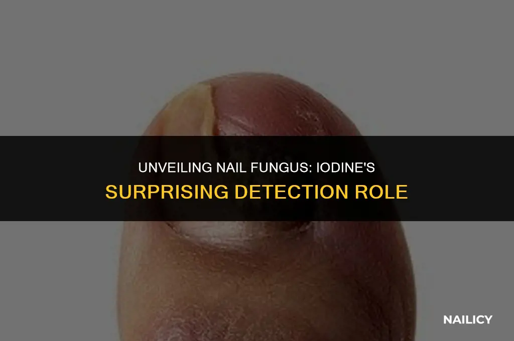 can iodine show where nail fungus is