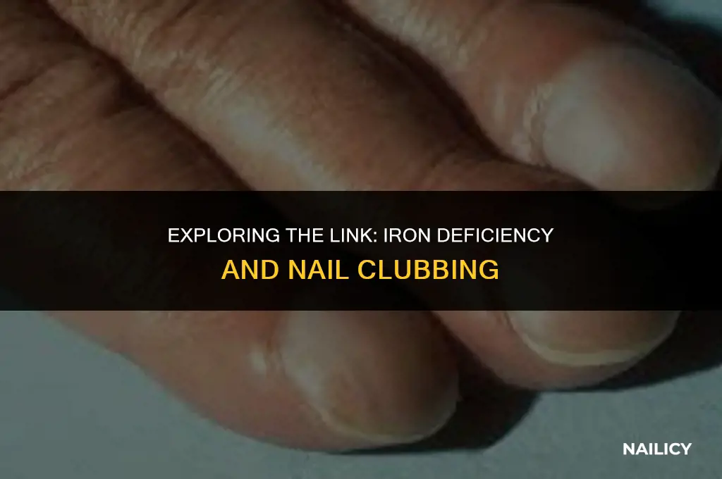 can iron deficiency cause nail clubbing