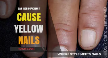 Unveiling the Truth: Iron Deficiency and Yellow Nails Connection